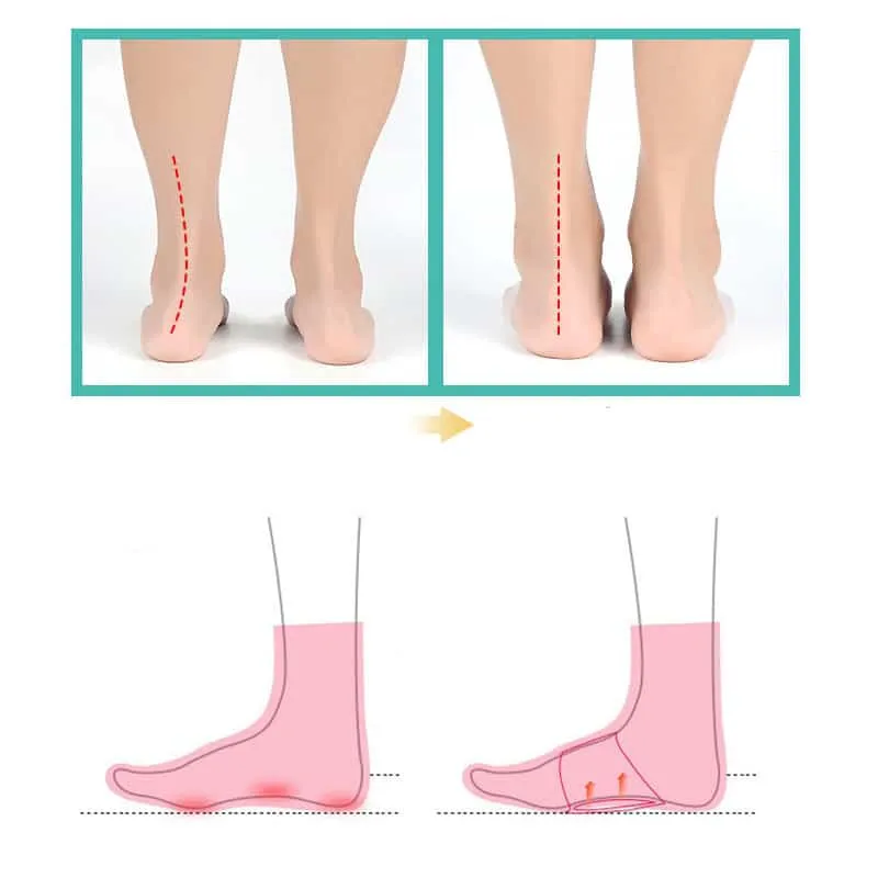 Lot de 4 pièces orthopédiques en silicone pour pieds plats • Boutique orthopédique (FR)